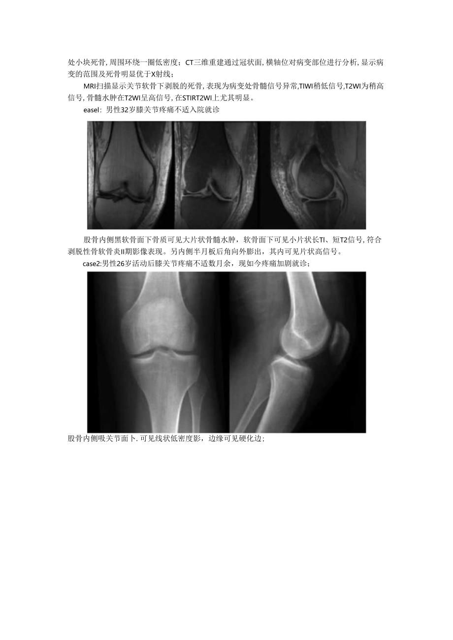 剥脱性骨软骨炎的影像诊断与影像表现.docx_第2页