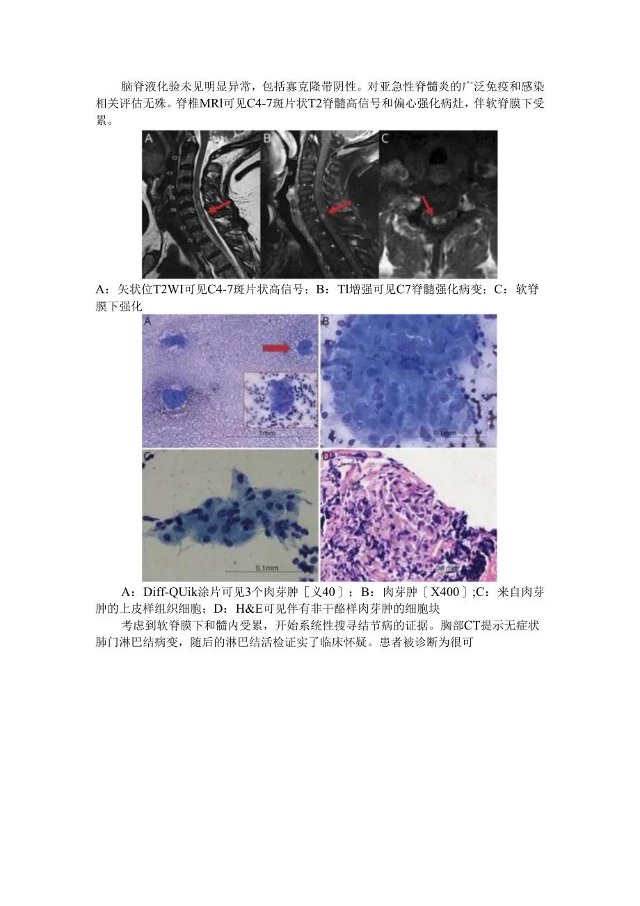 CNS神经结节病（脊髓神经结节病）治疗 病例探究.docx_第3页