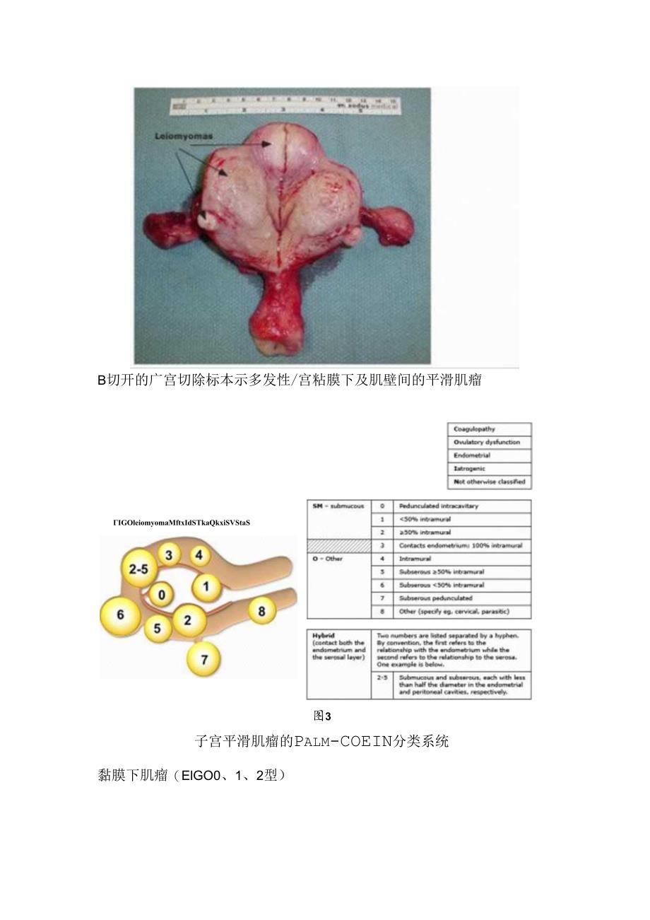 临床黏膜下肌瘤、肌壁间肌瘤等子宫肌瘤分类位置分类.docx_第2页