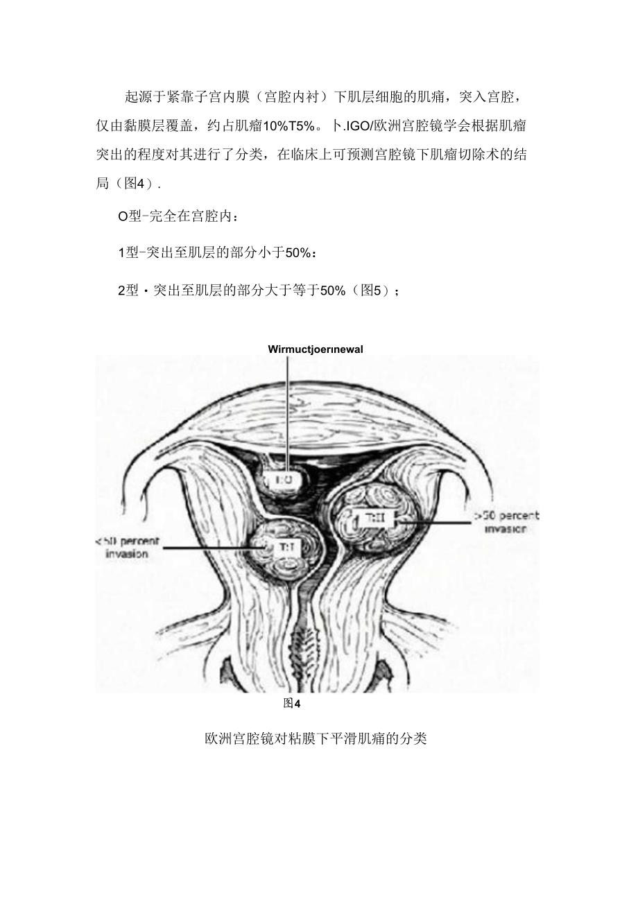 临床黏膜下肌瘤、肌壁间肌瘤等子宫肌瘤分类位置分类.docx_第3页