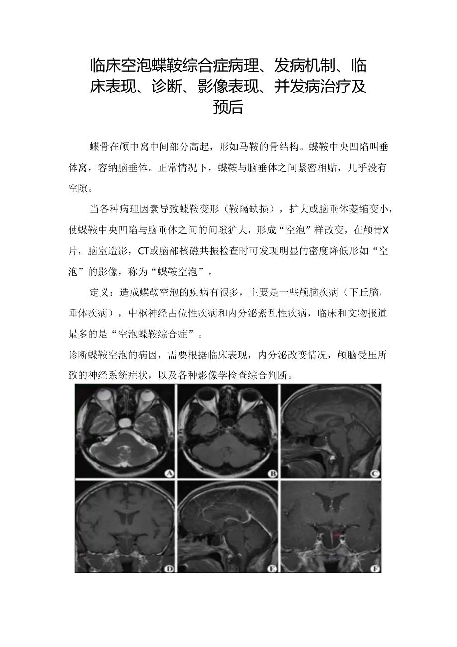 临床空泡蝶鞍综合症病理、发病机制、临床表现、诊断、影像表现、并发病治疗及预后.docx_第1页