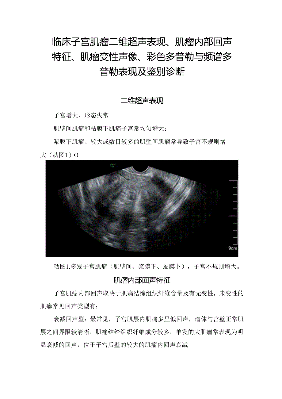 临床子宫肌瘤二维超声表现、肌瘤内部回声特征、肌瘤变性声像、彩色多普勒与频谱多普勒表现及鉴别诊断.docx_第1页