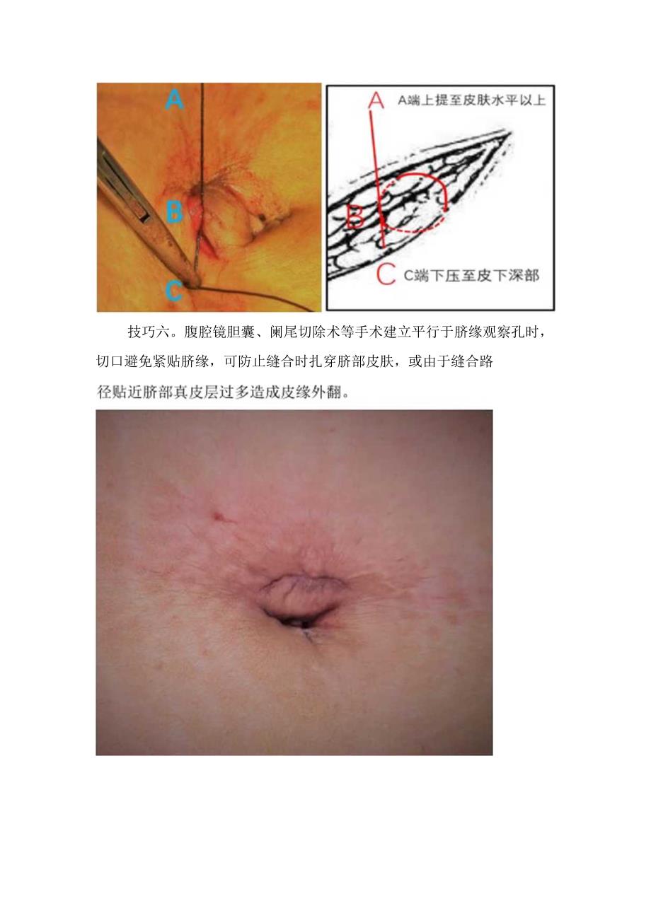 临床腹腔镜戳卡切口皮下缝合技巧要点.docx_第3页