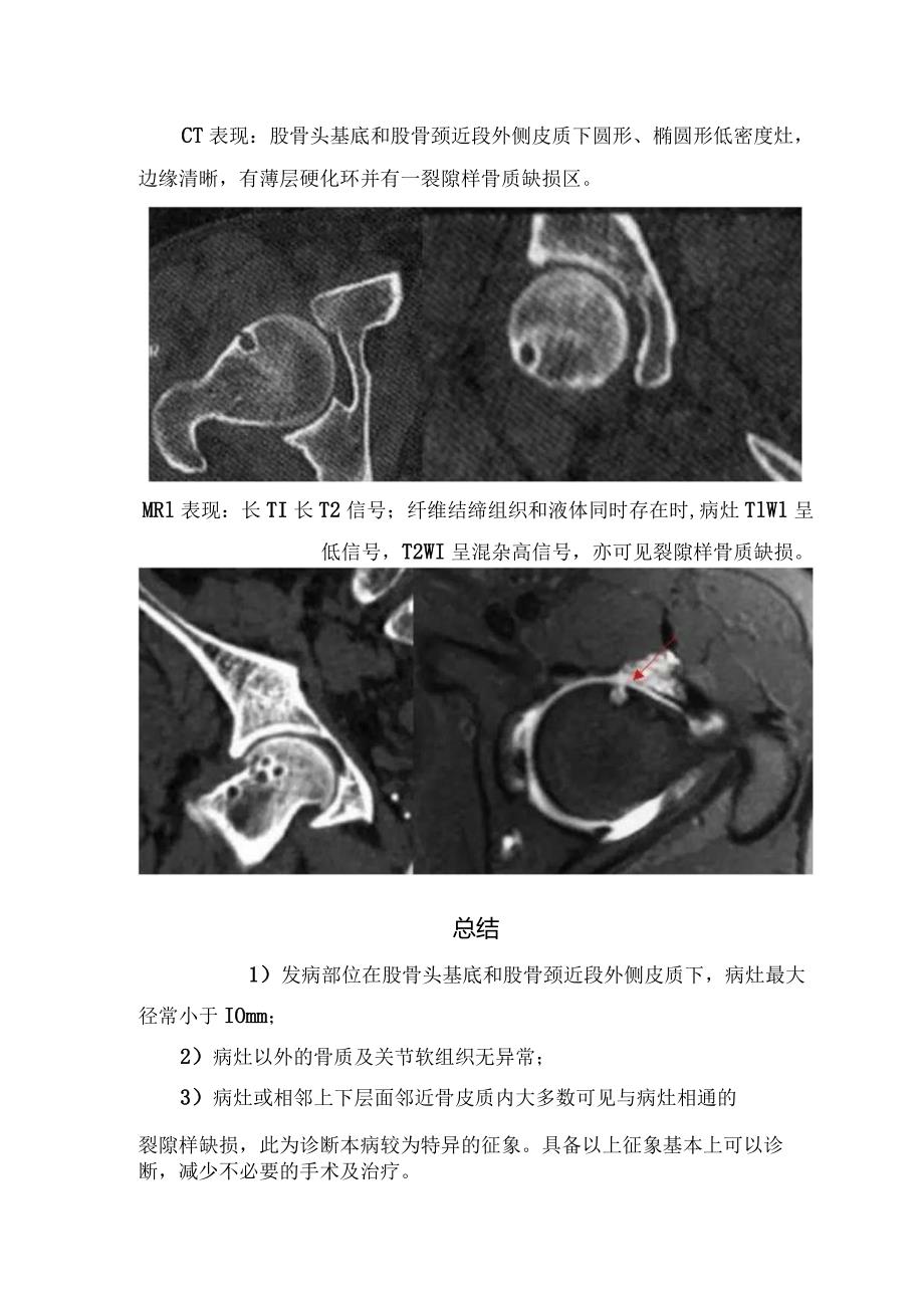 临床股骨颈疝窝病理、发病机理、影像表现、总结及鉴别诊断.docx_第2页