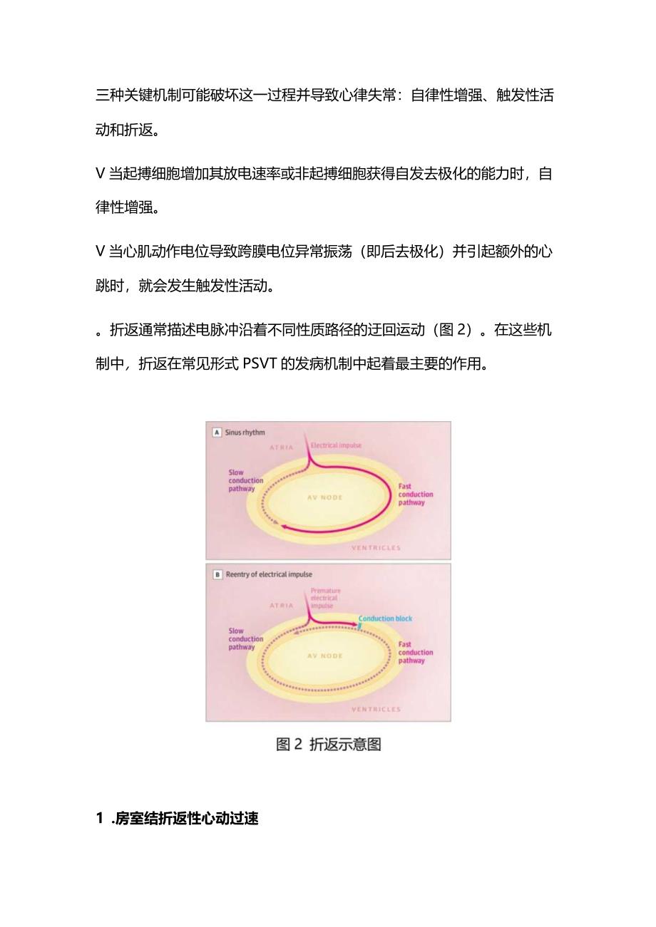 2024阵发性室上性心动过速诊断与管理.docx_第2页