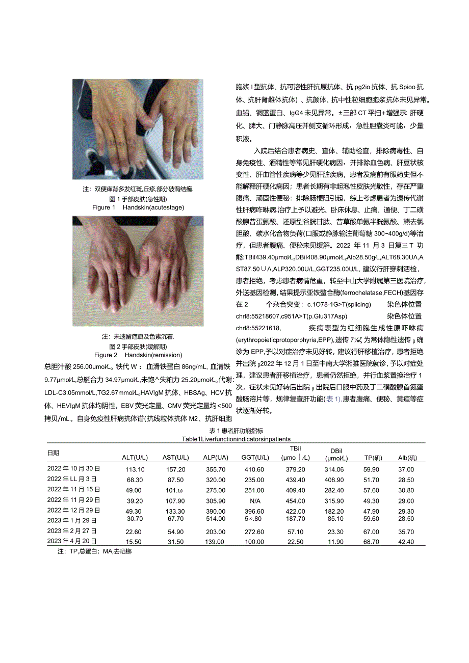 以肝硬化为主要表现的红细胞生成性原卟啉病1例报告.docx_第2页