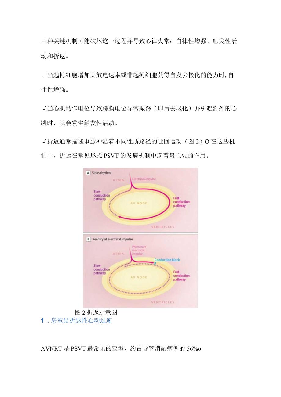 2024阵发性室上性心动过速诊断与管理.docx_第2页