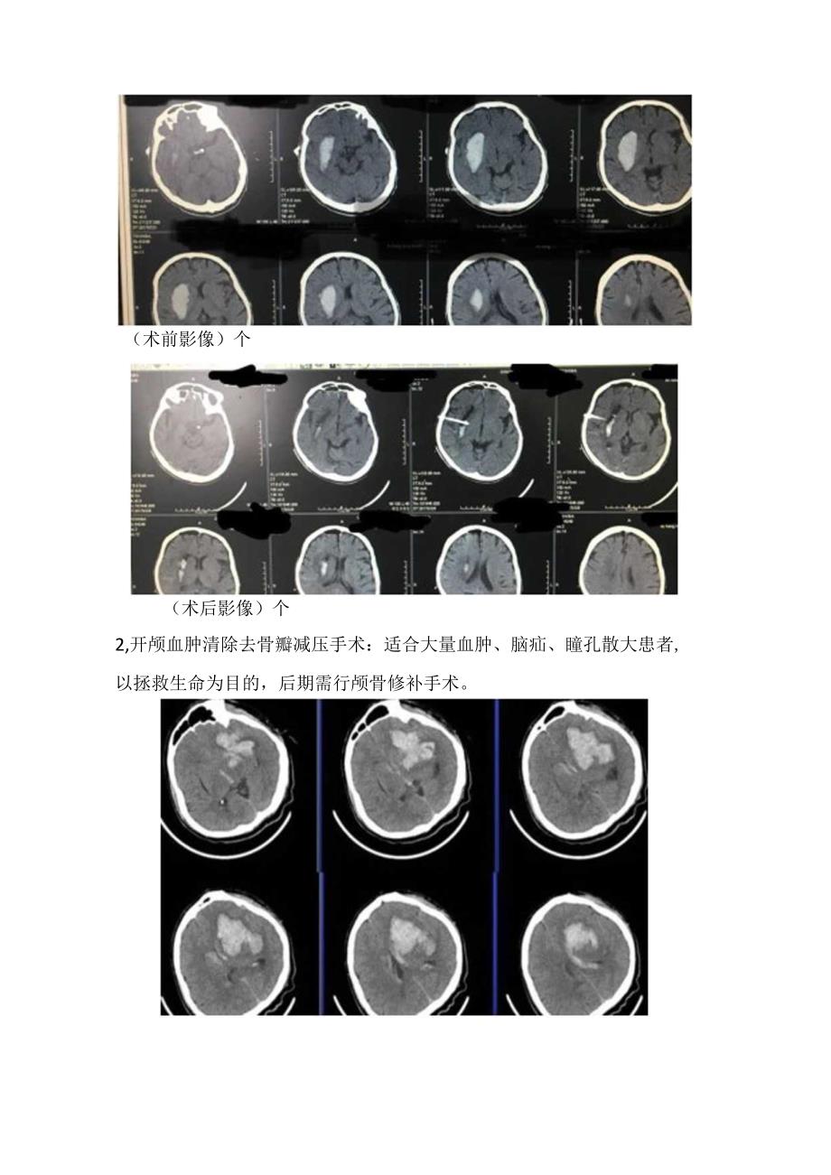 临床高血压脑出血原因、危害、需要患者、外科手术方式等要点总结.docx_第3页