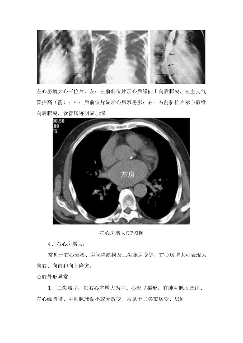 临床心脏增大、心包异常、肺循环异常等循环系统基本病变影像学表现.docx_第2页