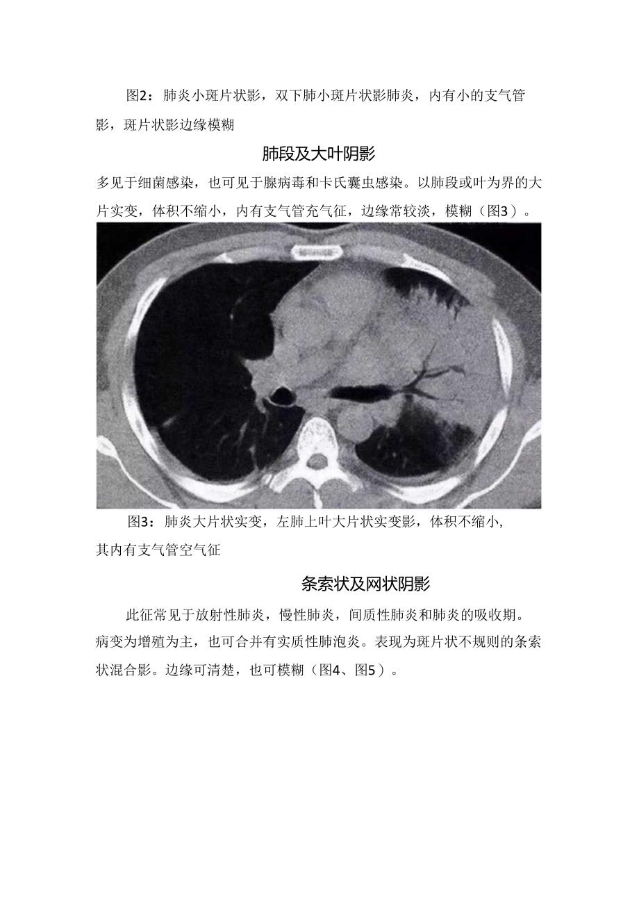 临床小结节影、 肺段及大叶阴影、球形阴影、空洞、胸膜病变等肺部炎症CT表现.docx_第2页