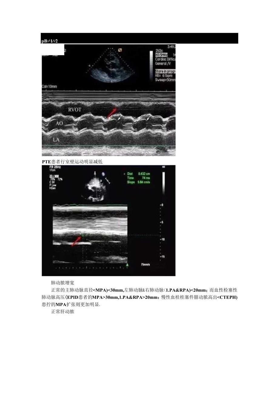 超声心动图九大征象看肺动脉栓塞与超声鉴别诊断要点.docx_第2页